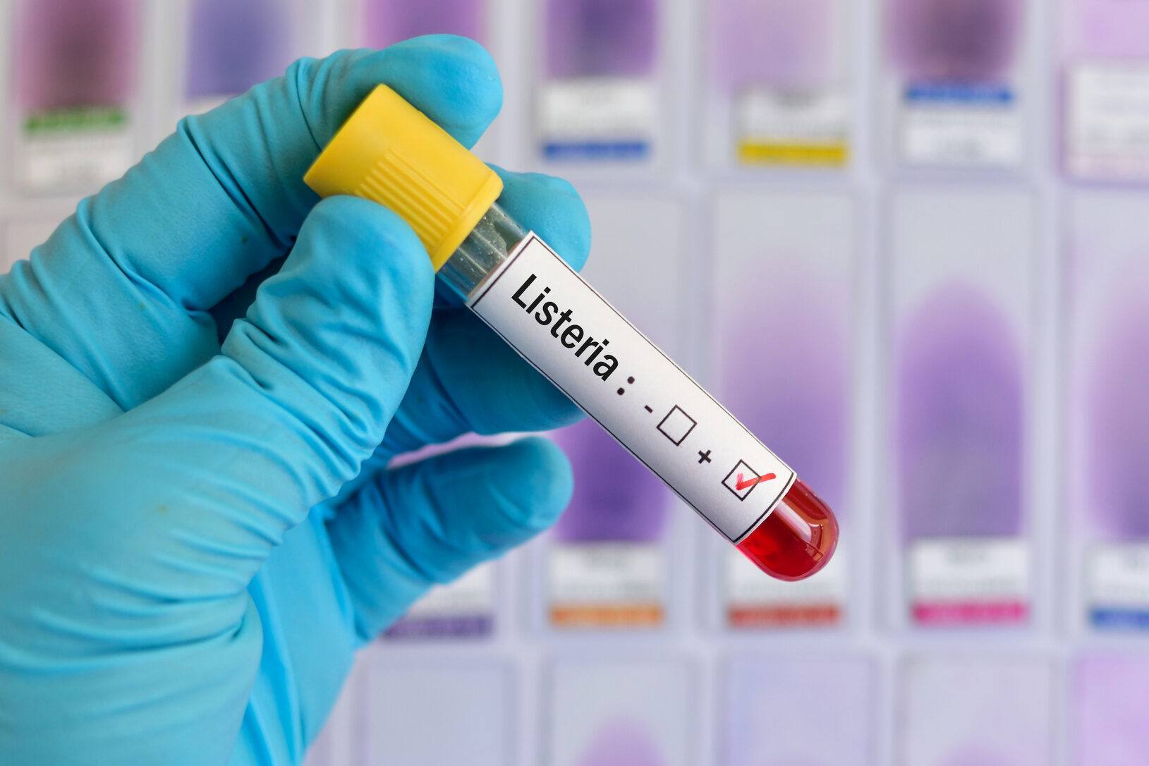 Campione di sangue in una provetta positivo per la listeriosi; concept: listeria monocytogenes