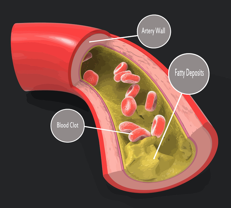 Noci, immagine schematica di un'arteria con depositi di grasso